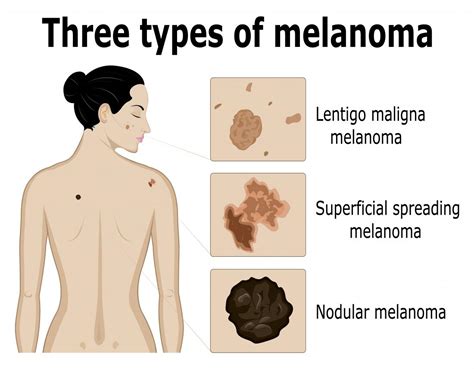 Malignant Melanoma Types A Superficial Spreading Melanoma B Images