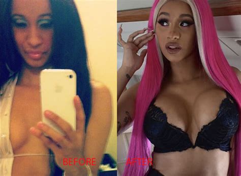 Cardi B Before And After Plastic Surgery Teeth Breast Implants