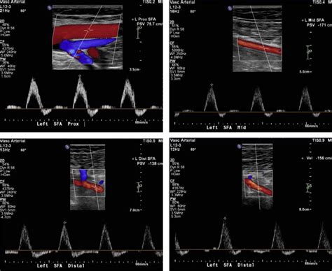 Doppler Ultrasound Of Left Lower Extremity Superficial Femoral Artery