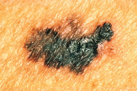 Know The Warning Signs Of Melanoma The Most Deadly Form Of Skin Cancer
