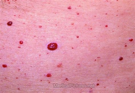 Cherry Angiomas Cherry Angiomas Cherry Angioma Red Dots On Skin