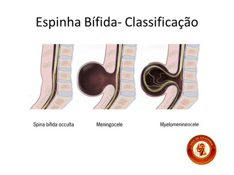 Defeitos Do Tubo Neural