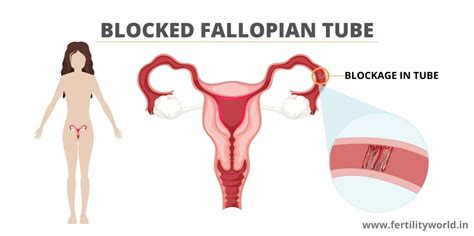 Blocked Fallopian Tube Fertilityworld