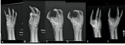 Cureus Pollicization Of Long Finger After Traumatic Amputation Of