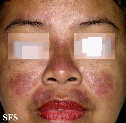 Facial Rashes Due To Rheumatoid Arthritis Naked Images
