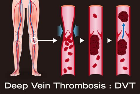 Can A Dvt Cause Pain Without Swelling Or Redness Scary Symptoms