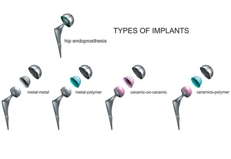 Different Types Of Hip Replacement Implants Add More To Life Meril