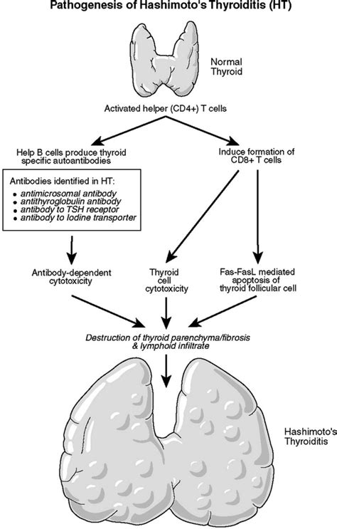 Pathophysiology And Clinical Presentation Hashimoto S Disease Case