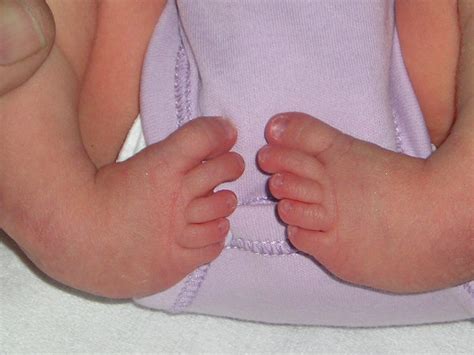 Club foot - Musculoskeletal Medicine for Medical Students ...
