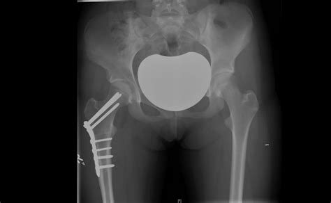 Proximal Femoral Derotation Osteotomy For Idiopathic Excessive Femoral