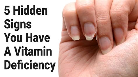 How To Know If You Have A Vitamin Deficiency