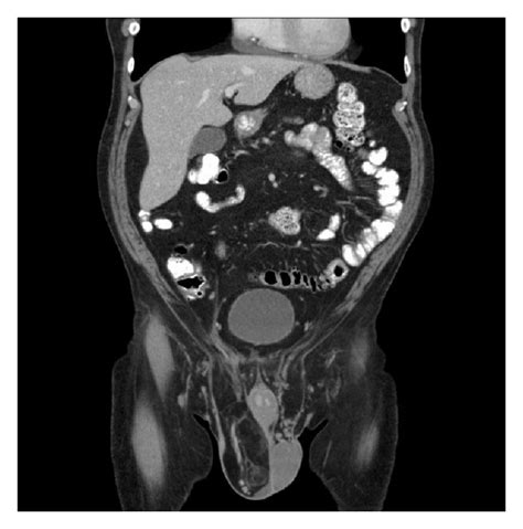 Ct Abdomenpelvis Read As A Large Fat Containing Inguinal Hernia