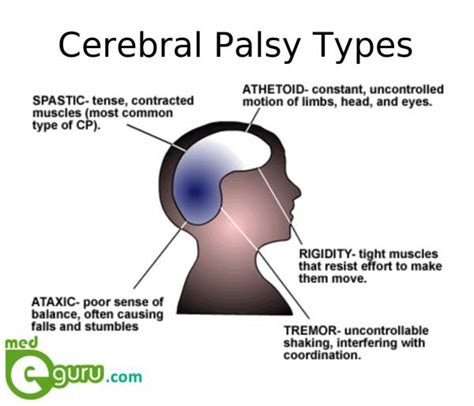 What Is Cerebral Palsy Therapies For Cerebral Palsymed E Guru