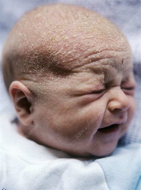 Cradle Cap Stock Image M1300785 Science Photo Library