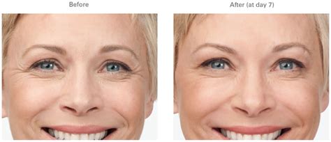 Botox Crows Feet Before And After Galleries Pictures Chugay