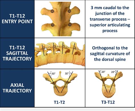 Entry Point And Trajectory Chart For Thoracic Pedicle Screw Placement Download Scientific