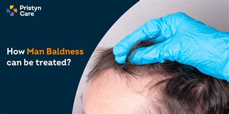 What Is Male Pattern Hair Loss Or Baldness How Can It Be Treated