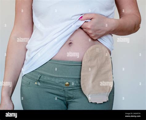 Colostomy Bag In Skin Color Attached To Young Woman Patient Close Up