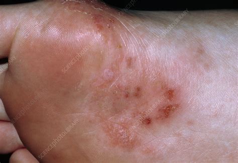 The Sole Of A Foot Affected By Pompholyx Eczema Stock Image M150