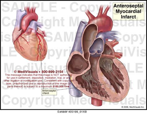 Anteroseptal Myocardial Infarct Medical Illustration Medivisuals