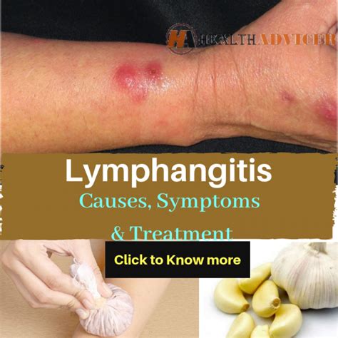 Lymphangitis Causes Picture Symptoms And Treatment