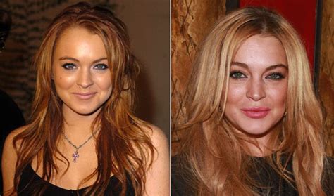 Lindsay Lohan Before And After Plastic Surgery