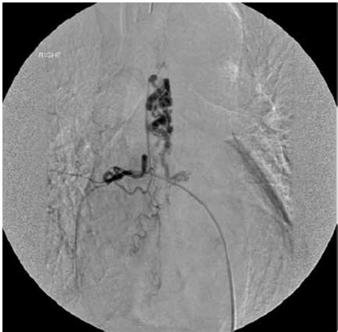 Spinal Angiogram Shows The Spinal Arteriovenous Fistula At T7 Level