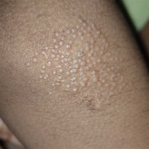 My Kid Has This Type Of Pimples On His Elbowknees Fingers Etc What To