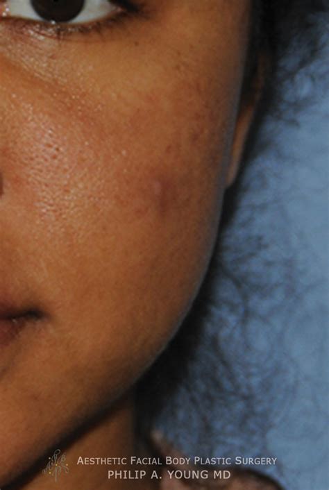 Acne Scar Treatment Bellevue Seattle