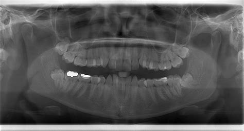 Pan X Ray Wisdom Teeth Gallery Dental