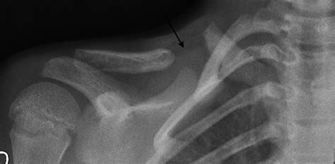 Fracture Of The Clavicle Or Skeletal Disorder Archives Of Disease In