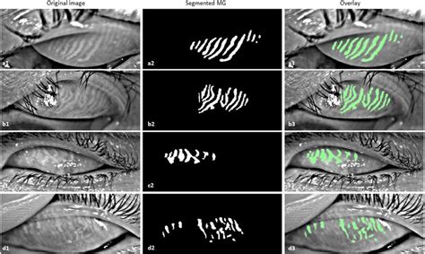 Deep Learning Based Automatic Meibomian Gland Segmentation And