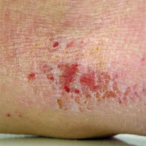13 Best Rashes Images On Pinterest Itchy Rash Med School And Medical