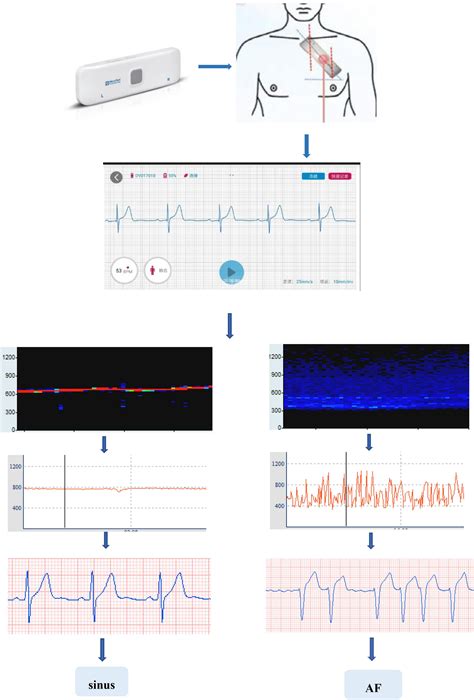Frontiers Long Term Single Lead Electrocardiogram Monitoring To