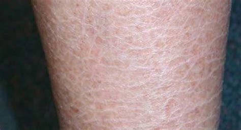 Ichthyosis Vulgaris Causes Symptoms And Diagnosis With Images Ichthyosis Dry Skin Home