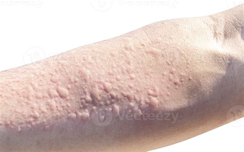 Allergic Reaction To Dust On Arm 22092294 Png