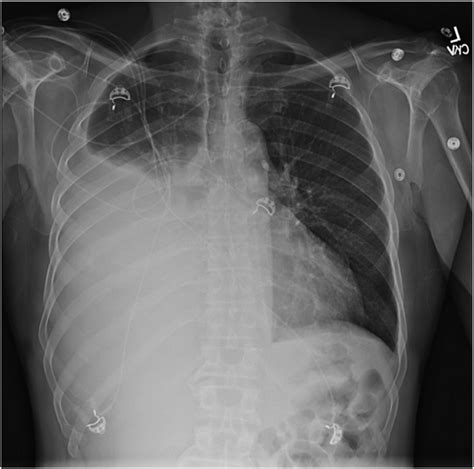 Chest X Ray On Admission Showing Large Right Pleural Effusion