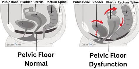 Pelvic Floor Dysfunction Prolapse The Backbone Osteopath Southgate