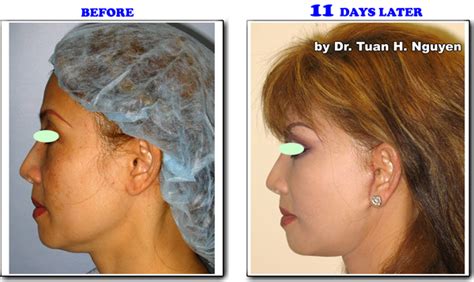 Facial Plastics Noble Care Outpatient Surgery Center Youngandpretty