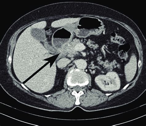 Abdominal Ct Scan Showing Diffuse Soft Tissue Density Between D2 And