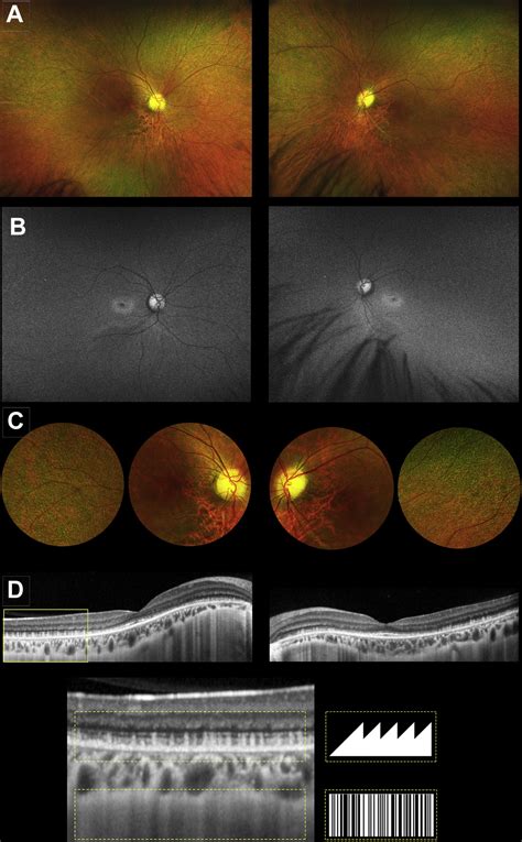Rpe65 Mutation Associated Fundus Albipunctatus With Cone Dystrophy