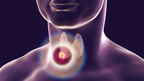 Thyroid Nodules Can They Be Reversed Total Health Center