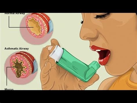 Asthma Bronchiale einfach erklärt YouTube