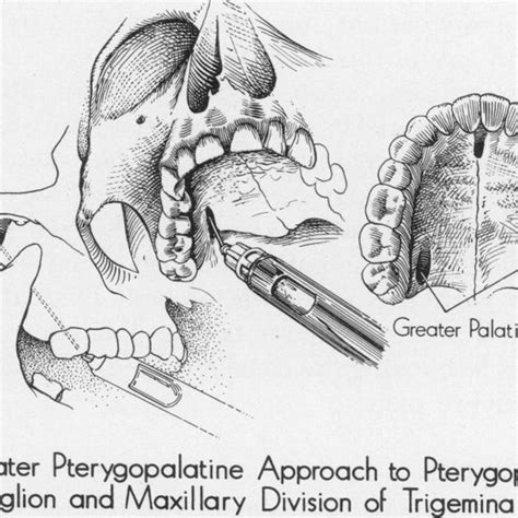 Pdf Maxillary Nerve Block Used Prior To Awake Nasal Intubation