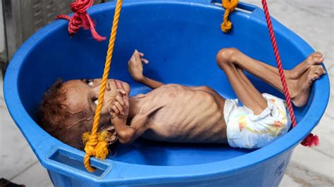 Five Million Children Risk Famine In War Torn Yemen Charity