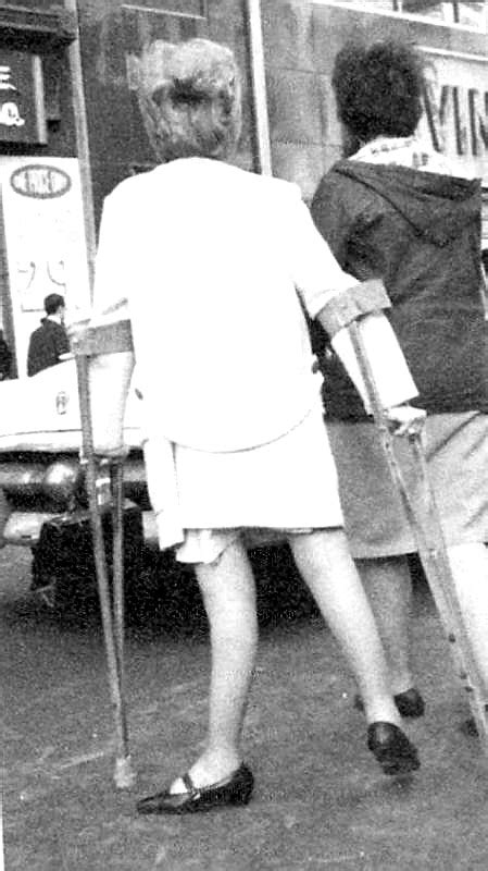 Unbraced Polio Legs 1 A 1960s Polio Girl Appears To Be T Flickr