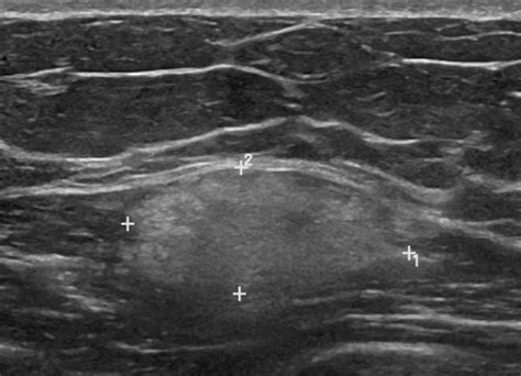 Ultrasound Showing Well Circumscribed Hyperechoic Mass In The Right