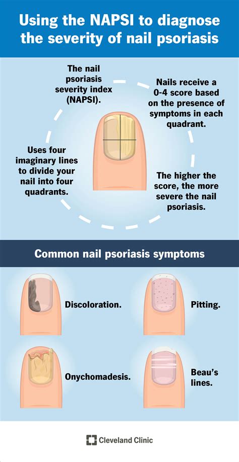 Nail Psoriasis What It Is Causes Nail Pitting Treatment