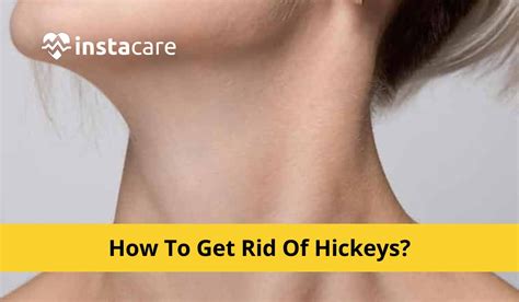 how to get rid of hickeys 8 easy tips that actually work