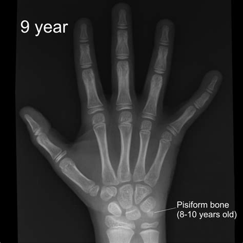 Child Hand X Ray Рентгенография МРТ КТ
